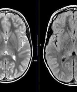 MRIOnline Mastery Series: Neurofibromatosis Type 1 (NF1) 2021