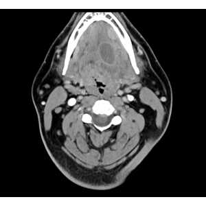 MRIOnline Imaging Mastery Series: Pathology of the Oral Cavity and Oropharynx 2020 (CME VIDEOS)