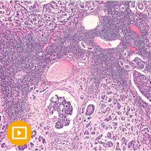 Breast Pathology 2023 (CME VIDEOS)
