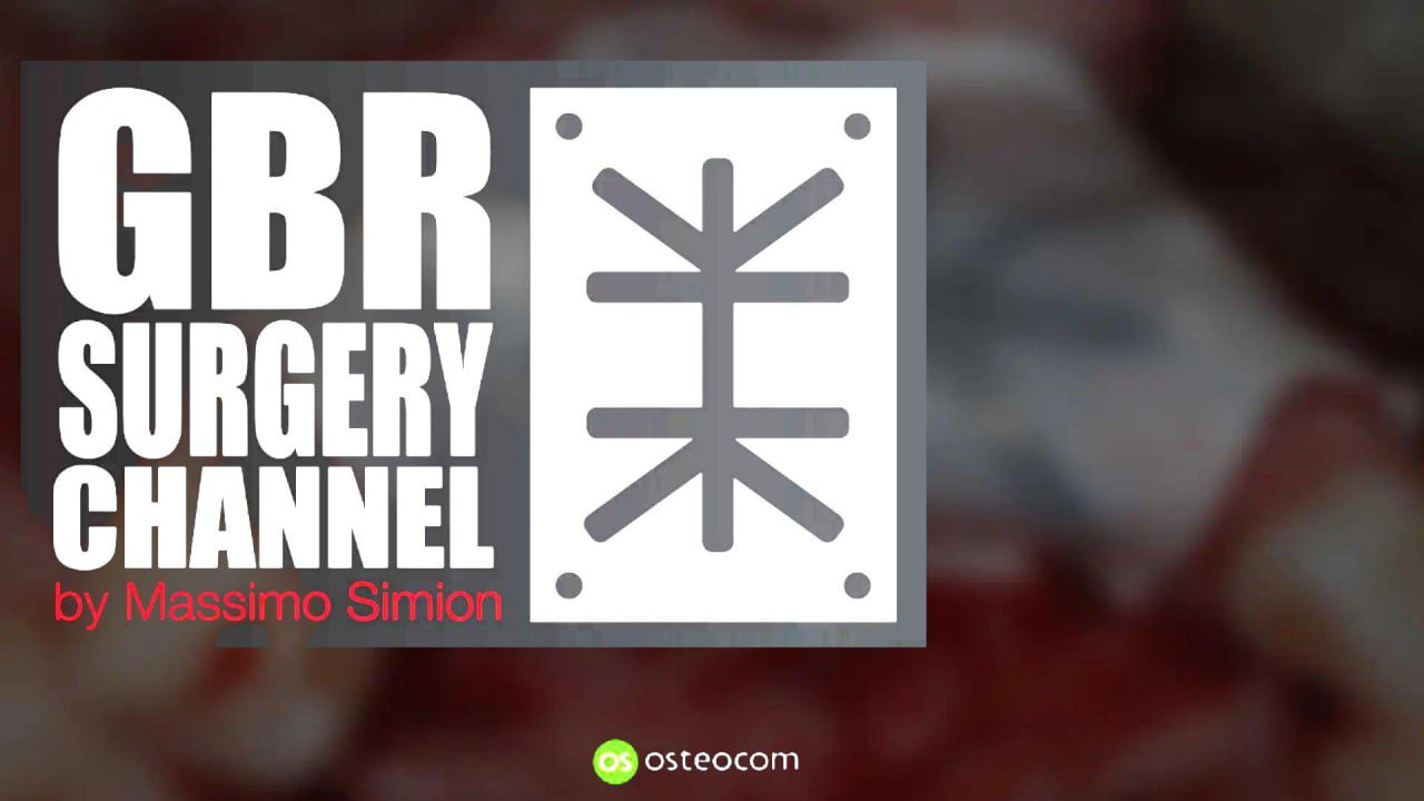 Osteocom GBR Surgery Channel (International) - Massimo Simion
