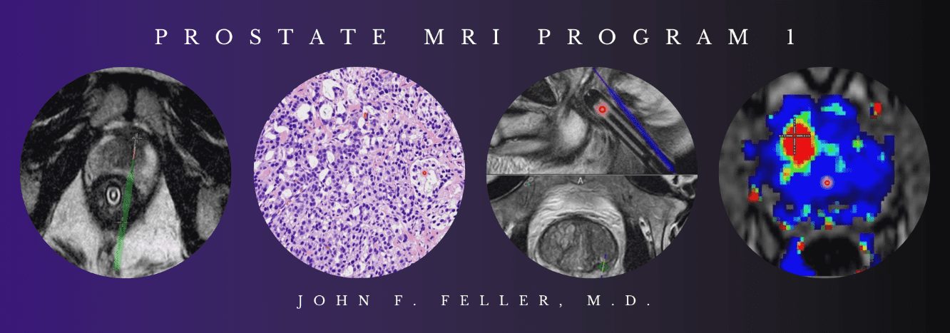 2021 Prostate MRI (Program 1) – John F. Feller, M.D (Videos)