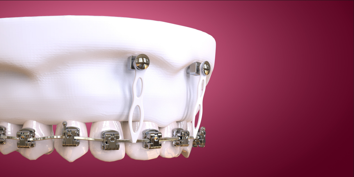OHI-S Microimplant Anchorage in Clinical Practice: Guide for Beginners and Intermediate