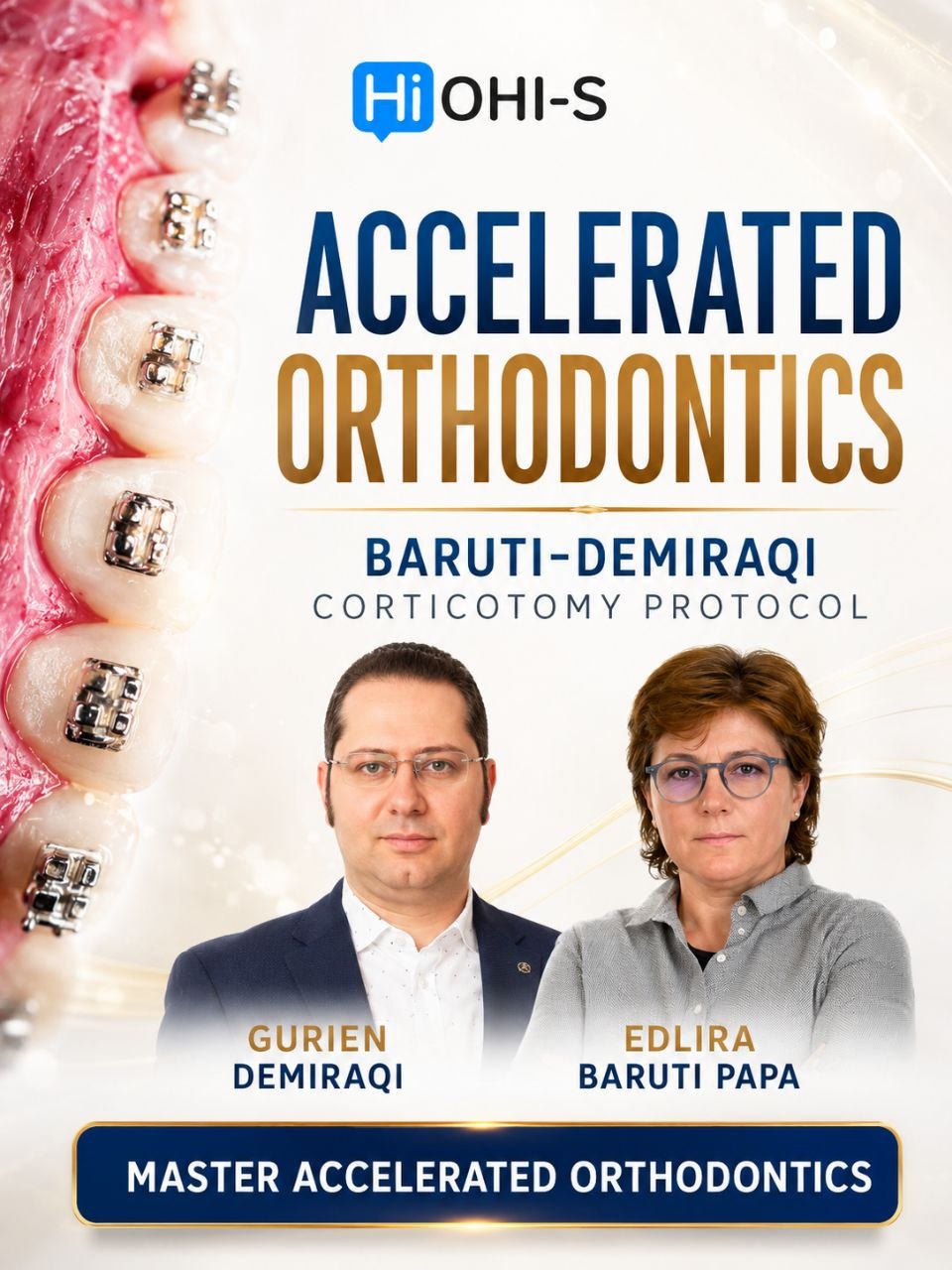 OHI-S Accelerated Orthodontic Baruti–Demiraqi Corticotomy Protocol